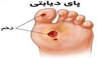 زخم پای دیابتی را جدی بگیرید